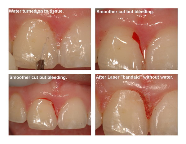 Gingivectomy and restoration Page3_resize.jpg